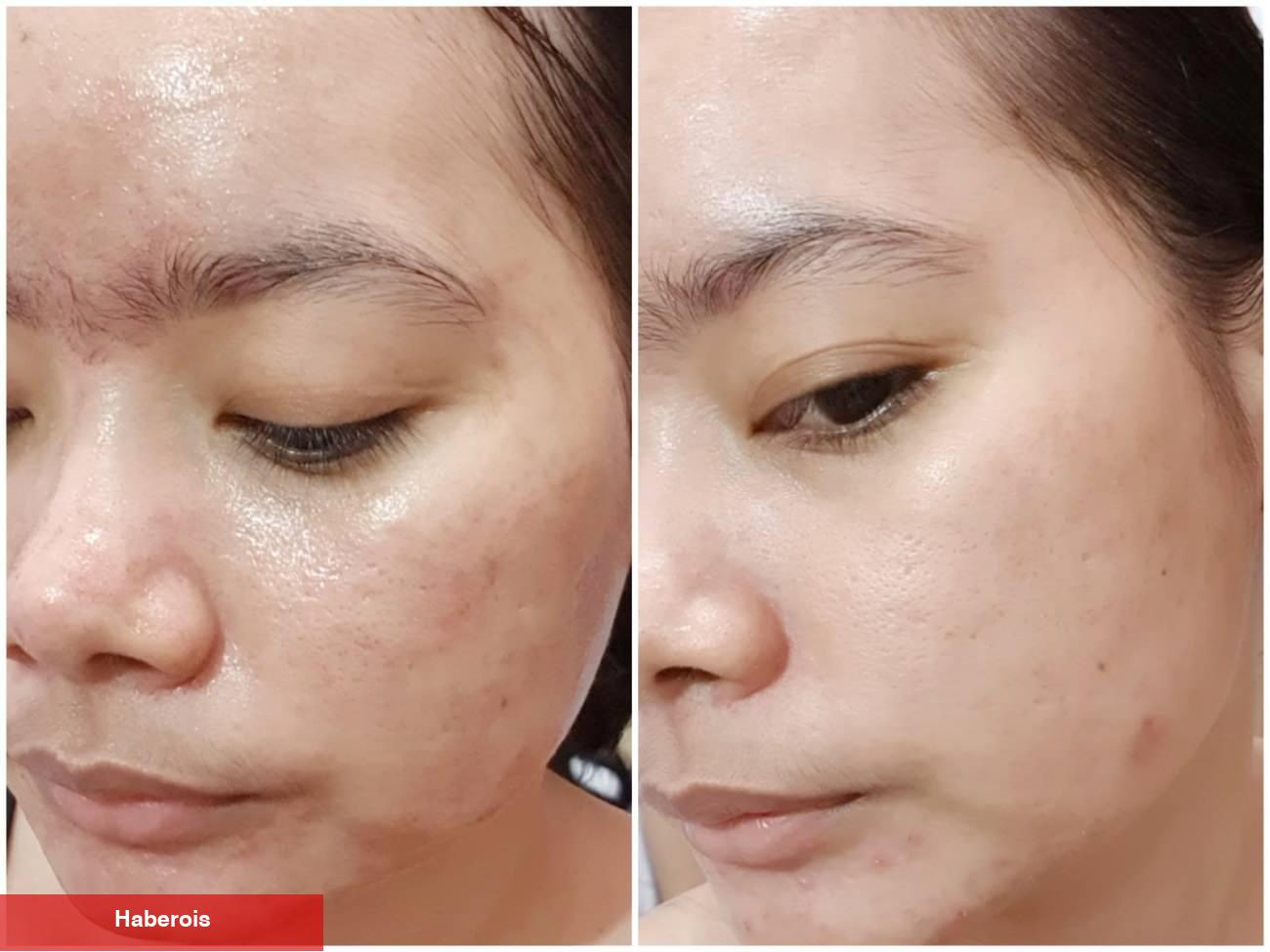 Kırmızı peeling nedir ve nasıl uygulanır? Kırmızı Peeling ne işe fayda?