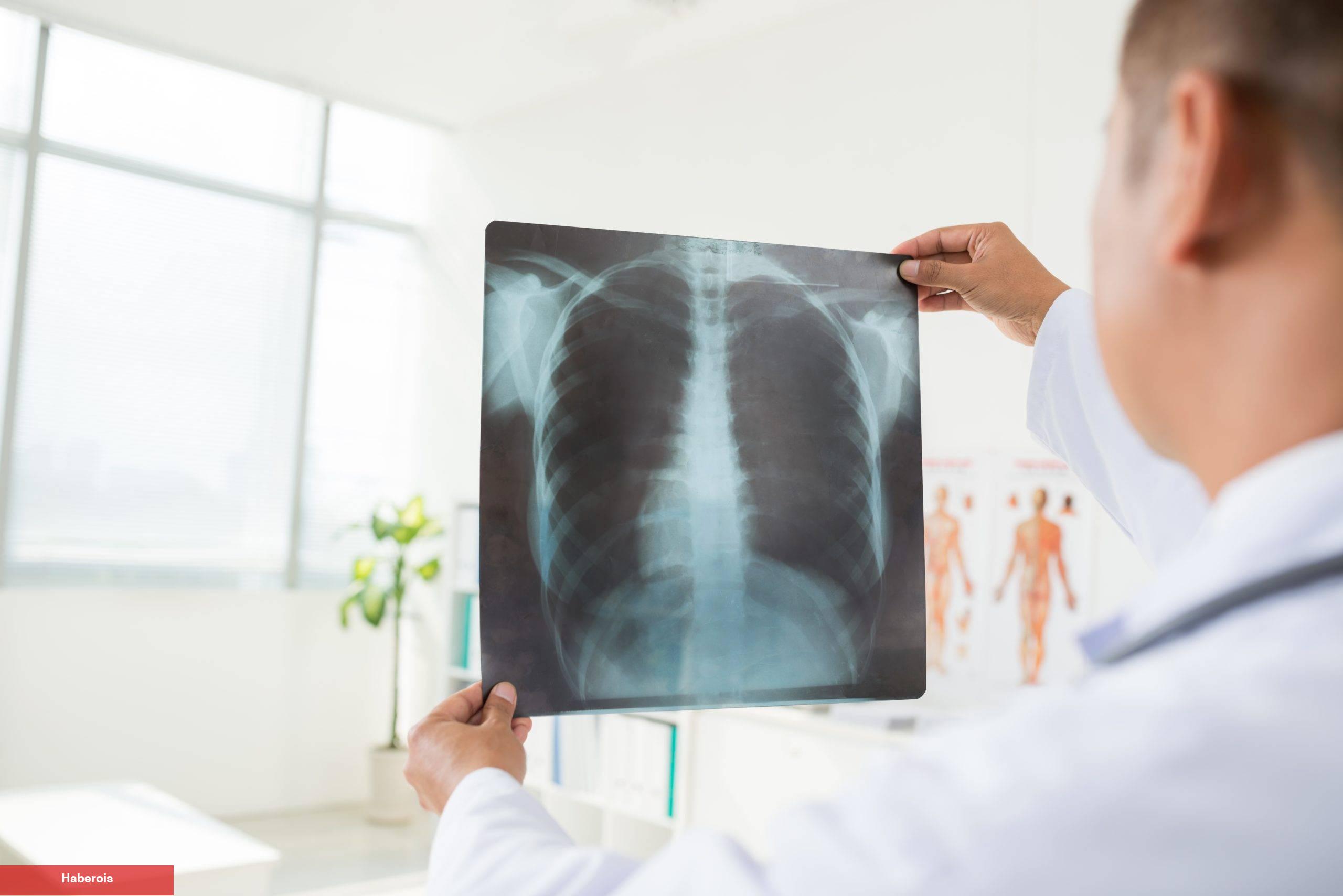 Akciğer Nakli Kimlere Uygulanabilir - Haberois Akciğer Nakli Kimlere Uygulanabilir