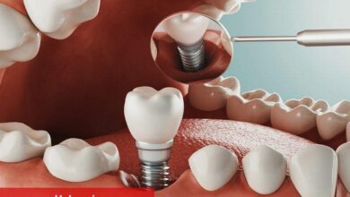 Diş tedavisinde implant zorlu bir süreç mi?