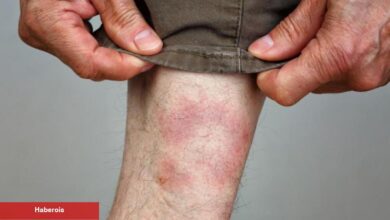 Lyme hastalığı nasıl ortaya çıkar? Lyme belirtileri nelerdir? Lyme hastalığı tedavisi