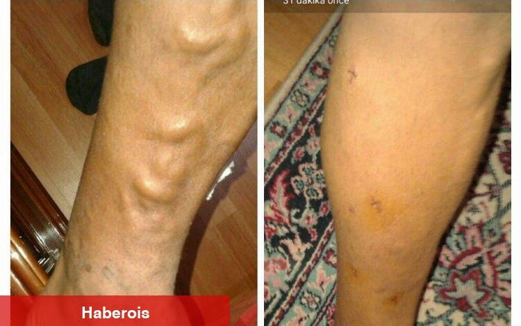 Sıcak havalarda varise dikkat! - Haberois Sıcak havalarda varise dikkat!