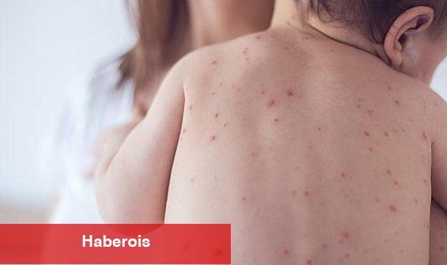Vakalar artıyor! 1 yaş altı bebekler ağır kızamık için risk altında! - Haberois Vakalar artıyor! 1 yaş altı bebekler ağır kızamık için risk altında!