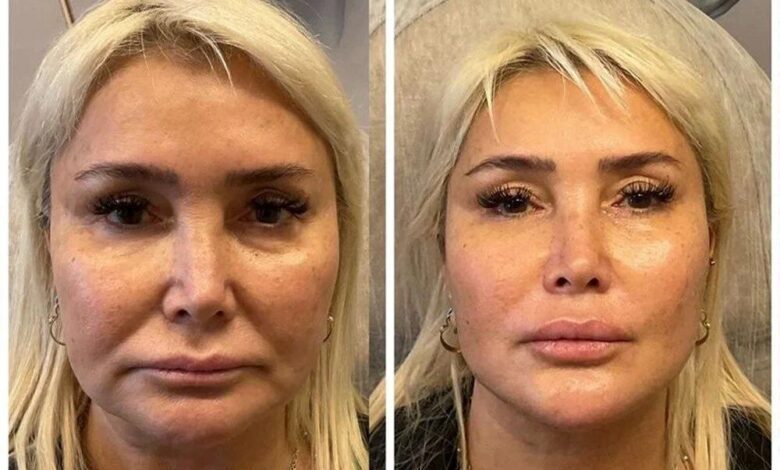 Yonca Evcimik’in şok edici estetik değişimi!