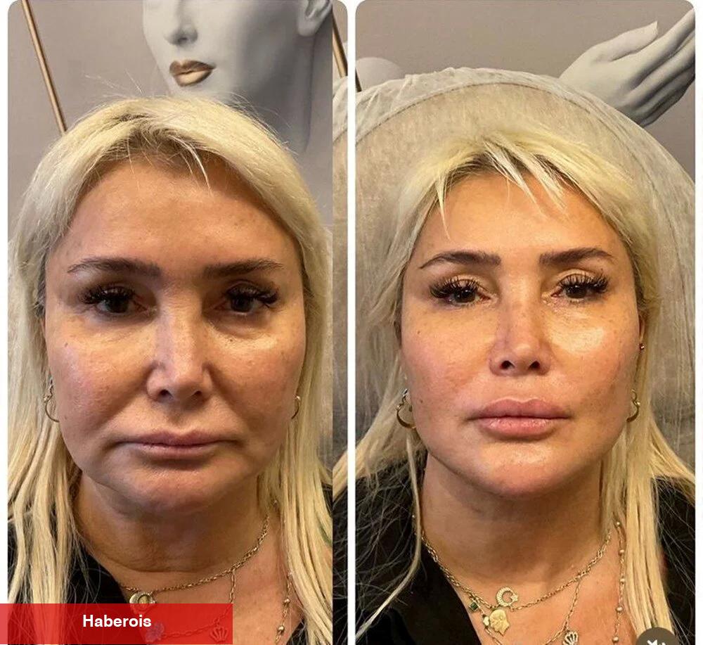 Yonca Evcimik’in şok edici estetik değişimi!