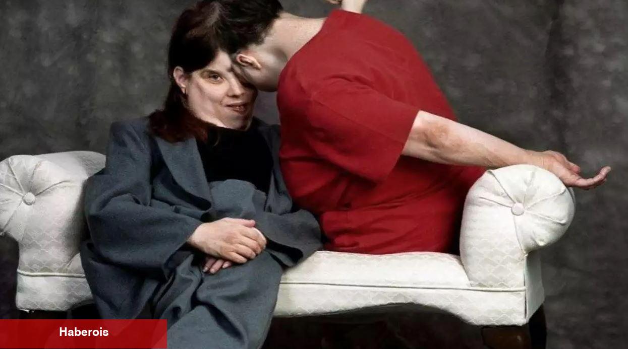 Dünyanın en yaşlı yapışık ikizleriydi! Lori ve George Schappell hayatını kaybetti