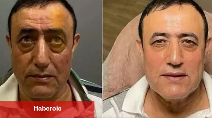 Halay virtüözü Mahmut Tuncer estetik kervanına katıldı! Yüz nakli yapsa bu kadar değişirdi