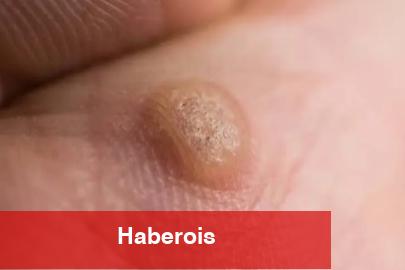 Ayakta ve genital bölgede çıkan siğile dikkat!