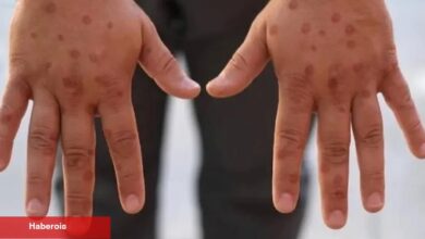 Maymun çiçeği virüsü hakkında bilinen yanlışlar