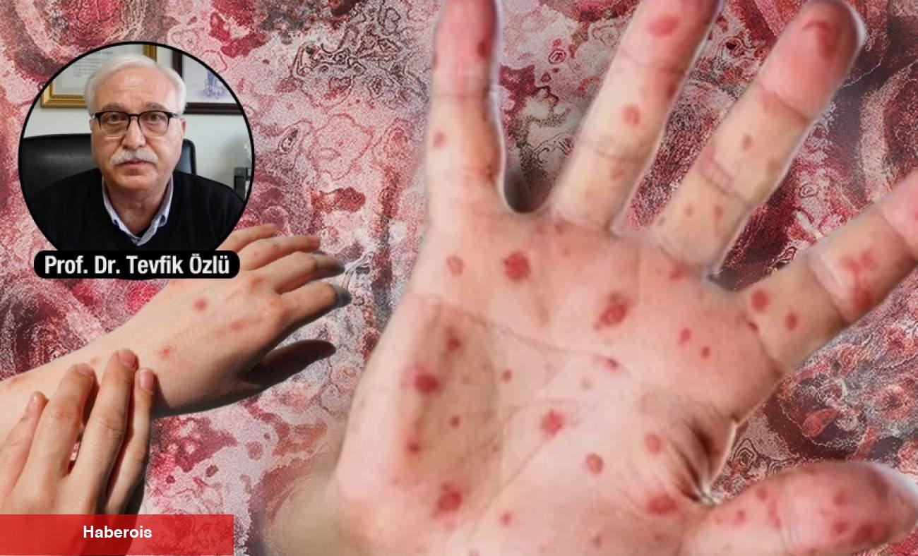 Maymun çiçeği virüsünde toplu taşımalara dikkat! 'Salgınlarla yaşamaya alışılmalı'