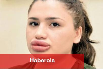 Merdiven altı botoks uygulamaları can alabilir