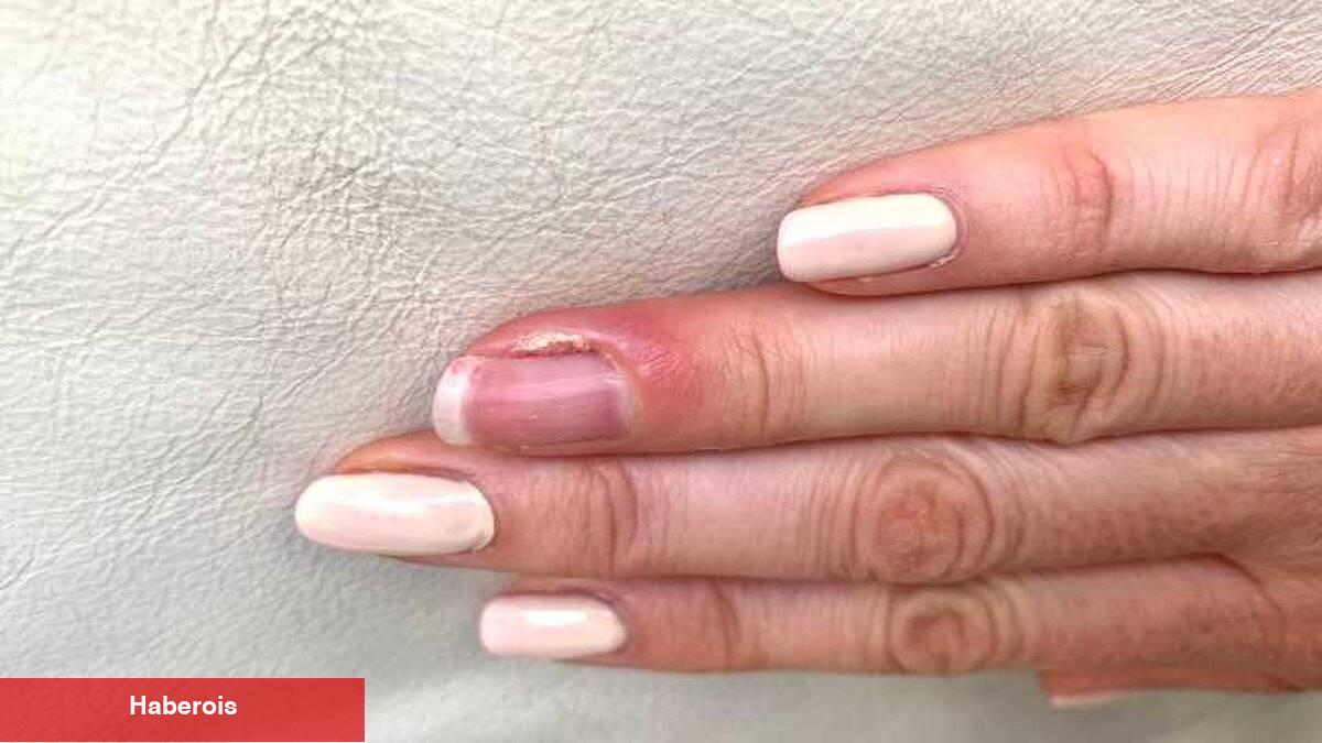 Ağrılı parmaklar için tahlil: Dolama nedir? - Haberois Ağrılı parmaklar için tahlil: Dolama nedir?