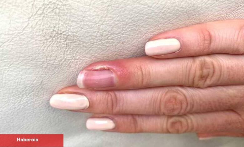 Ağrılı parmaklar için tahlil: Dolama nedir? - Haberois Ağrılı parmaklar için tahlil: Dolama nedir?
