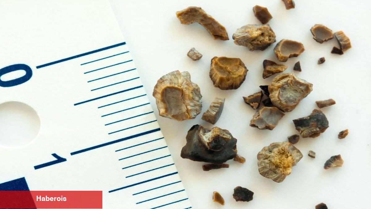 Böbrek taşı neden oluşur? - Haberois Böbrek taşı neden oluşur?