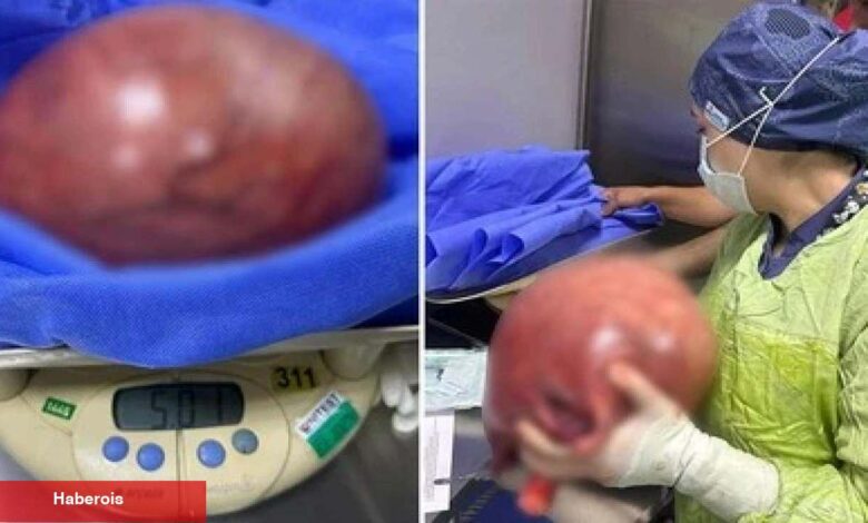 Karın ağrısı şikayetiyle gitti, karnından çıkanlar şoke etti! - Haberois Karın ağrısı şikayetiyle gitti, karnından çıkanlar şoke etti!