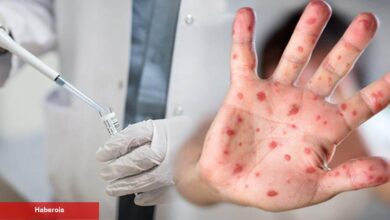 Maymun çiçeği virüsünde şaşırtan gelişme! Devası Sivas'tan çıktı