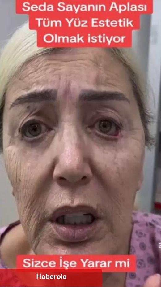 Seda Sayan'ın ablası resmen yüz nakli yaptırdı! Nursel Yıldız'ın son hali ortaya çıktı
