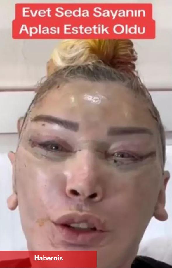 Seda Sayan'ın ablası resmen yüz nakli yaptırdı! Nursel Yıldız'ın son hali ortaya çıktı