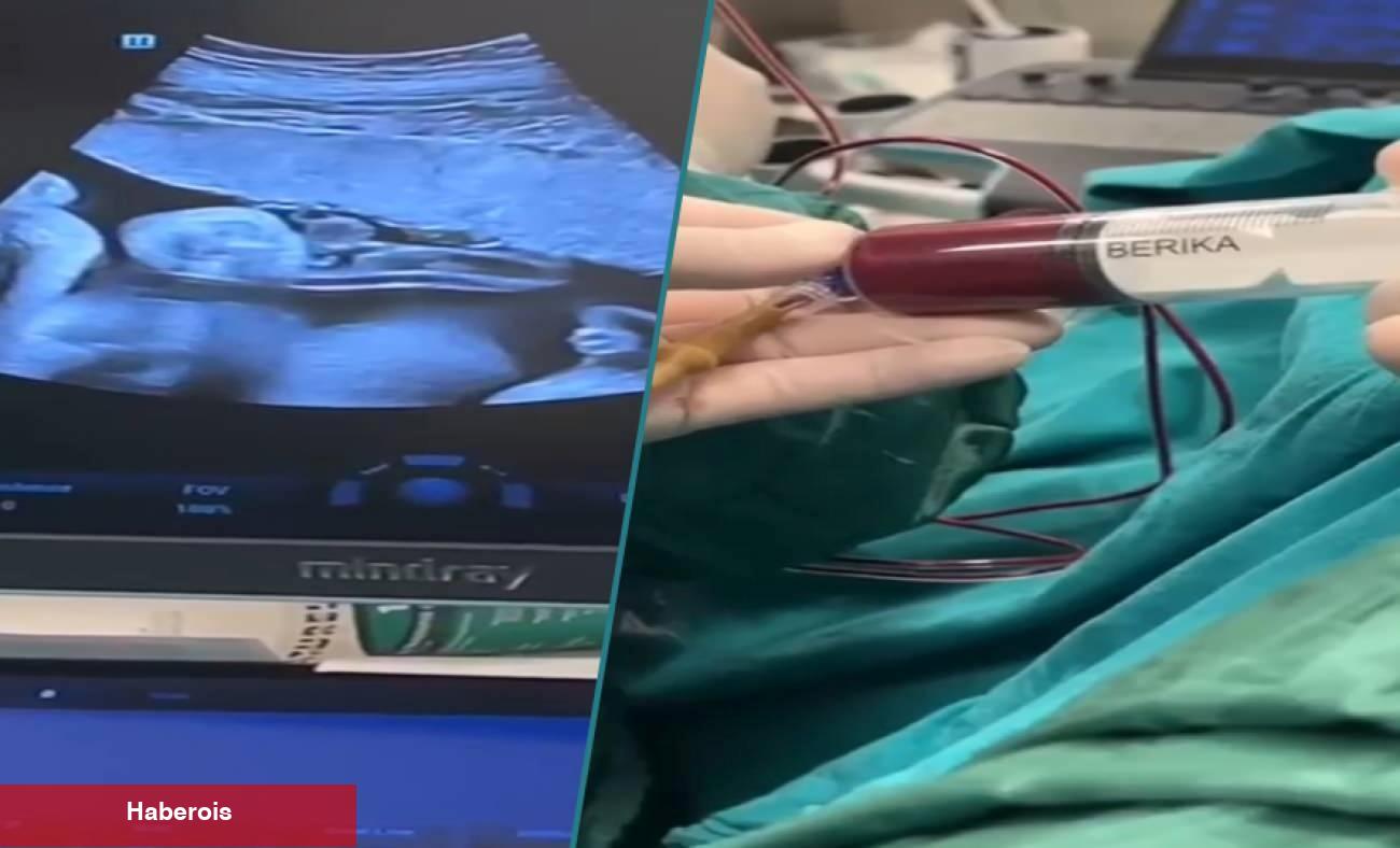 Anne karnındaki bebeğe kan nakli yapıldı
