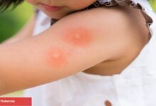 Bebek ve çocuklarda sivrisinek ısırıkları: Tedavisi ve tedbire yolları