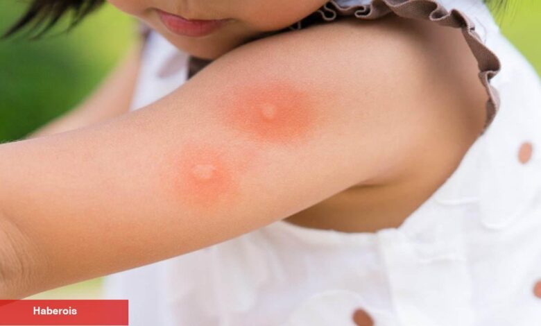 Bebek ve çocuklarda sivrisinek ısırıkları: Tedavisi ve tedbire yolları - Haberois Bebek ve çocuklarda sivrisinek ısırıkları: Tedavisi ve tedbire yolları