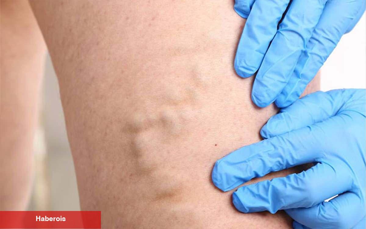 Varis deyip geçmeyin: Bacak sıhhatiniz alarm mı veriyor?
